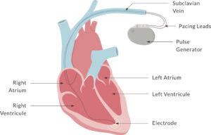 Your Heart Health Matters: New Cardiac Procedure Available